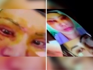 “Yuzimni aroq ichib kesib tashladi”. Toshkentda soxta kosmetolog er-xotinlar qo‘lga olindi