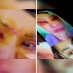 “Yuzimni aroq ichib kesib tashladi”. Toshkentda soxta kosmetolog er-xotinlar qo‘lga olindi