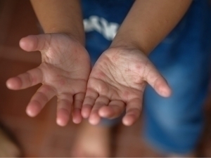 Has a new virus spread among children? The Sanitary and Epidemiological Committee comments