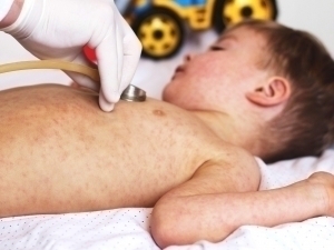 Qozog‘istonda qizamiq aniqlangan bolalar maktab va bog‘chalardan chetlashtiriladi