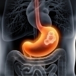 Ошқозон-ичак саратонининг яширин сабаби аниқланди