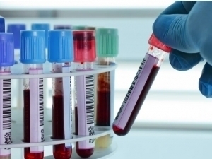 Олимлар саратоннинг янги турини аниқлади