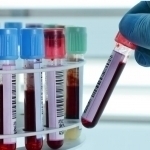 Olimlar saratonning yangi turini aniqladi