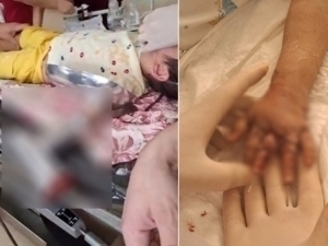 Навоийда 3 яшар қизнинг қўли гўшт майдалагичга кириб кетди