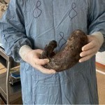 Шифокорлар 18 ёшли қизнинг ошқозонидан 4 кг соч ўрамини чиқариб олди