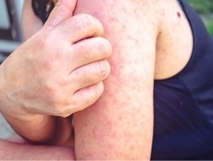 Лондонда 60 дан ортиқ бола қизамиқ билан касалланди