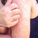 Лондонда 60 дан ортиқ бола қизамиқ билан касалланди