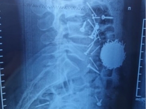 Samarqandda 29 yoshli erkakning qornidan 200 gr mix olib tashlandi