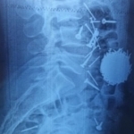 Samarqandda 29 yoshli erkakning qornidan 200 gr mix olib tashlandi