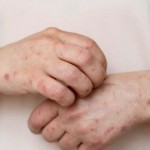 70 дан ортиқ бола қизамиқ юқтириб олди. Мактаблар онлайн шаклга ўтиши мумкин