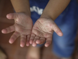 No evidence of new coxsackie virus outbreak among children in Uzbekistan