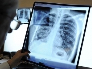 Erkak yakuniy bosqichdagi saraton bilan 40 yil yashadi