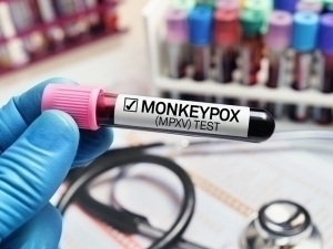 Rossiyada maymunchechak aniqlandi