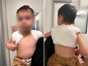 Toshkentdagi xususiy bog‘chada 3 yoshli bolaning yelkasi sindi