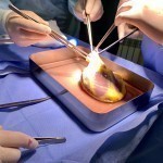 O‘zbekistonda a’zo transplantatsiyasi uchun donorga qo‘yiladigan muhim talab bekor qilinmoqda