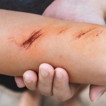 Яраларни тезда битирадиган янги даволаш усули ишлаб чиқилди